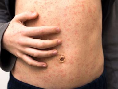 measles-rash-gty-jt-221122_1669155112087_hpMain_7_4x3t_384.jpg